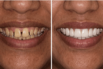 Before and after dental transformation